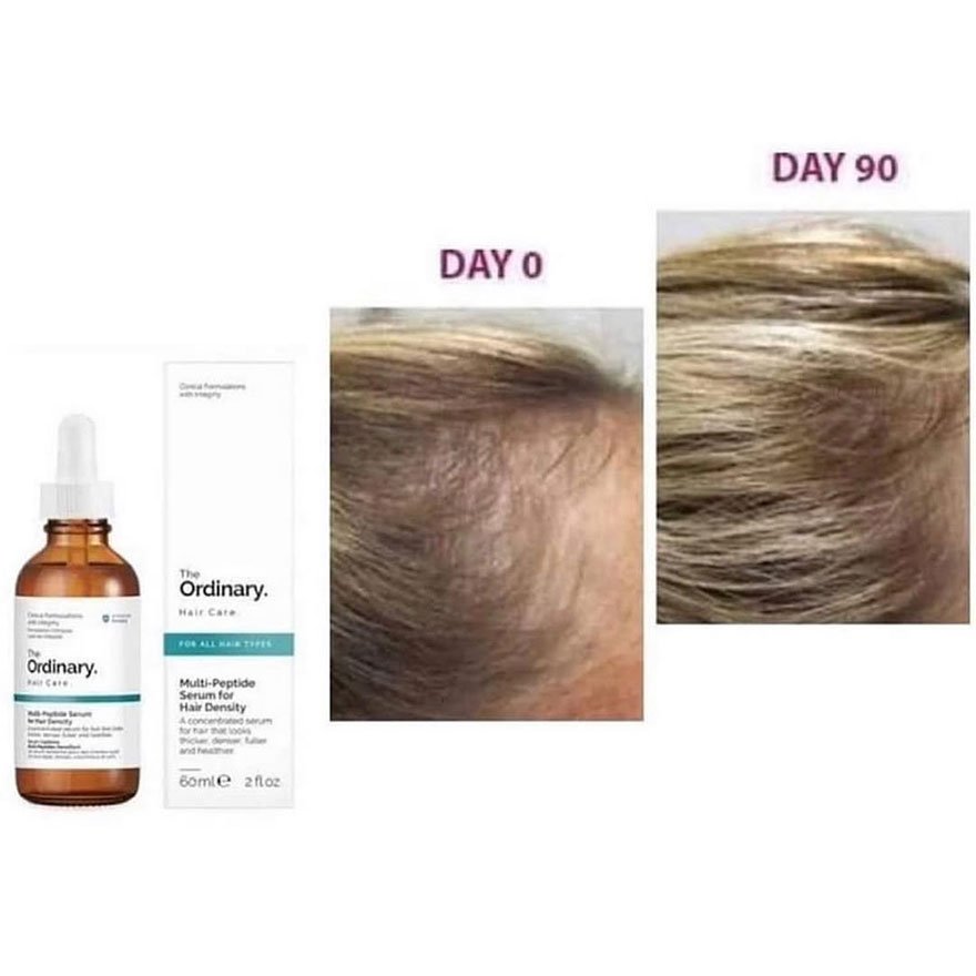 The Ordinary Multi-Peptide Serum for Hair Density bottle and box shown beside before-and-after scalp photos labeled Day 0 and Day 90.